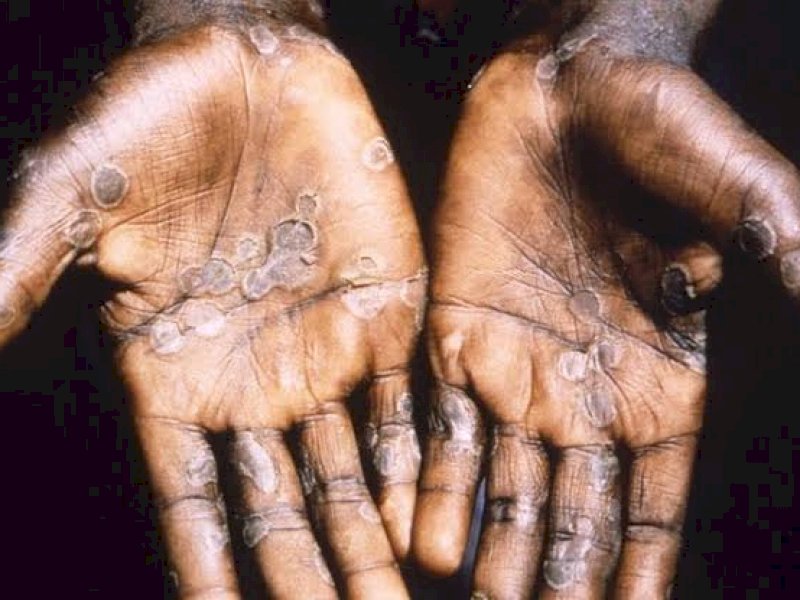 Penampakan cacar monyet yang saat ini mewabah di beberapa negara. (int) 