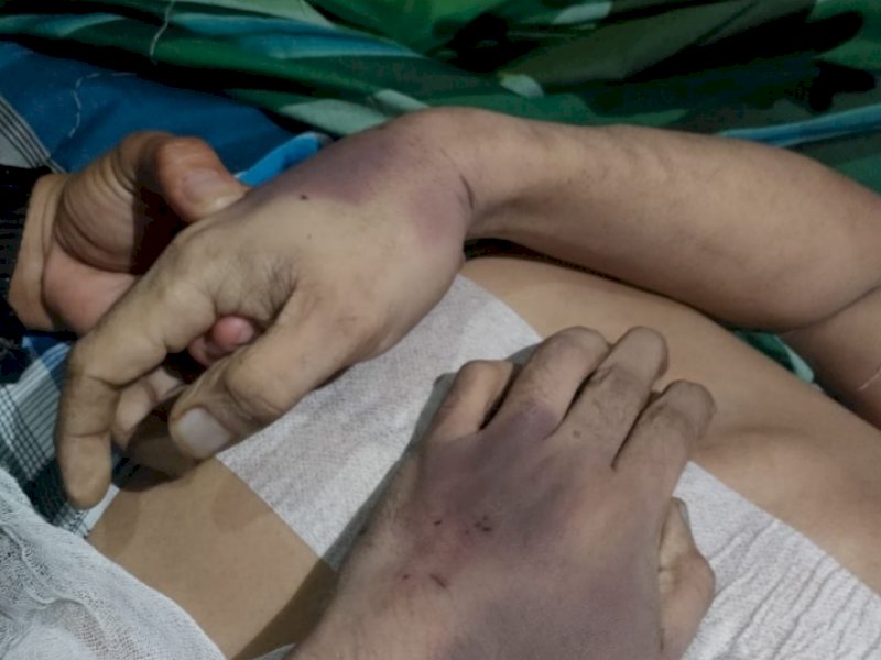 Foto Andi Lolo yang disebar keluarga menunjukkan luka lebam di sekujur tubuhnya.