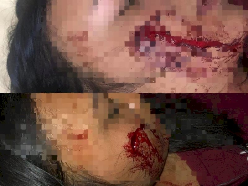 Tega! Pria di Torut Tikam Pipi dan Hantam Kepala Adik Iparnya Pakai Double Stick