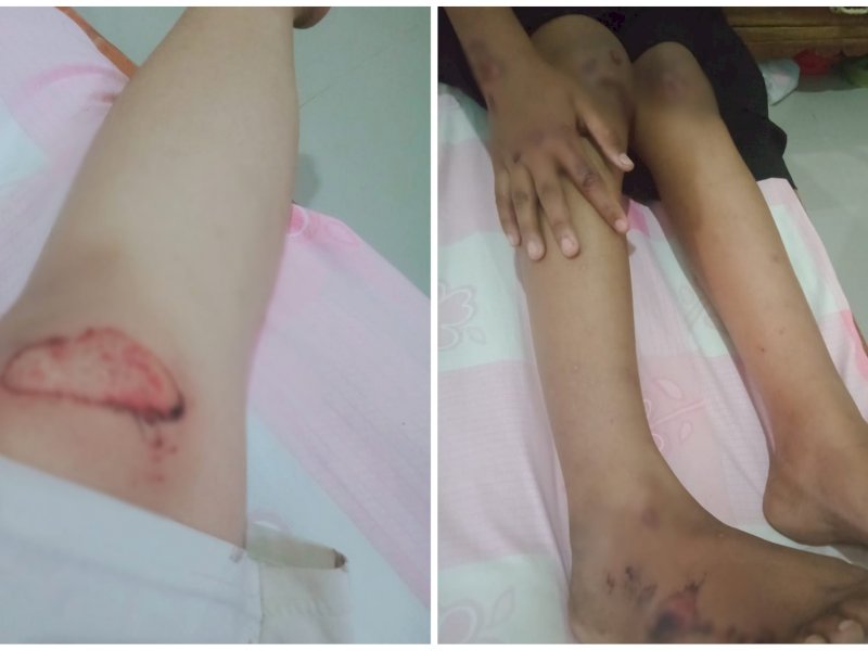 Luka yang dialami dua orang wanita yang menjadi korban tabrak lari. 